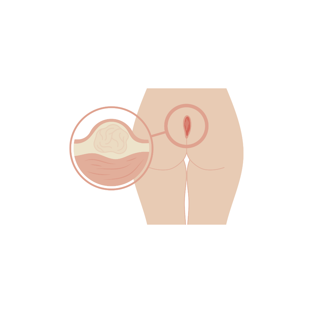 Imagem da especialidade: CIRURGIA DE CISTO PILONIDAL COM LASER
